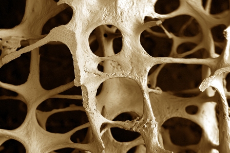 Osteoporosis y destruciones periodontales